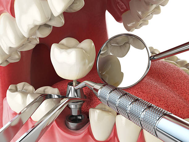 Best Emergency Dental Care for Abscessed Tooth in Queensland, MD